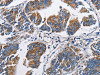 The image on the left is immunohistochemistry of paraffin-embedded Human colon cancer tissue using CSB-PA704716 (NPPA Antibody) at dilution 1/60, on the right is treated with fusion protein. (Original magnification: ×200)