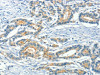 The image on the left is immunohistochemistry of paraffin-embedded Human colon cancer tissue using CSB-PA133826 (ASAH2 Antibody) at dilution 1/50, on the right is treated with fusion protein. (Original magnification: ×200)