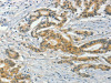 The image on the left is immunohistochemistry of paraffin-embedded Human colon cancer tissue using CSB-PA215341 (ASB8 Antibody) at dilution 1/50, on the right is treated with fusion protein. (Original magnification: ×200)