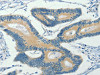 The image on the left is immunohistochemistry of paraffin-embedded Human colon cancer tissue using CSB-PA193476 (ASB8 Antibody) at dilution 1/30, on the right is treated with fusion protein. (Original magnification: ×200)