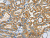 The image on the left is immunohistochemistry of paraffin-embedded Human thyroid cancer tissue using CSB-PA305079 (ASCC1 Antibody) at dilution 1/30, on the right is treated with fusion protein. (Original magnification: ×200)