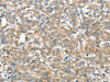 The image on the left is immunohistochemistry of paraffin-embedded Human esophagus cancer tissue using CSB-PA305079 (ASCC1 Antibody) at dilution 1/30, on the right is treated with fusion protein. (Original magnification: ×200)