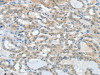 The image on the left is immunohistochemistry of paraffin-embedded Human thyroid cancer tissue using CSB-PA233816 (ASH2L Antibody) at dilution 1/60, on the right is treated with fusion protein. (Original magnification: ×200)