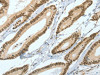 The image on the left is immunohistochemistry of paraffin-embedded Human colon cancer tissue using CSB-PA696621 (ASH2L Antibody) at dilution 1/50, on the right is treated with fusion protein. (Original magnification: ×200)