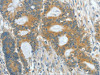 The image on the left is immunohistochemistry of paraffin-embedded Human colon cancer tissue using CSB-PA075666 (ASPA Antibody) at dilution 1/60, on the right is treated with fusion protein. (Original magnification: ×200)