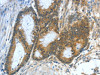 The image on the left is immunohistochemistry of paraffin-embedded Human colon cancer tissue using CSB-PA596240 (ASNS Antibody) at dilution 1/50, on the right is treated with fusion protein. (Original magnification: ×200)