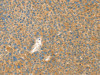 The image on the left is immunohistochemistry of paraffin-embedded Human liver cancer tissue using CSB-PA179815 (AANAT Antibody) at dilution 1/40, on the right is treated with fusion protein. (Original magnification: ×200)