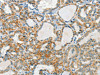 The image on the left is immunohistochemistry of paraffin-embedded Human thyroid cancer tissue using CSB-PA231814 (AANAT Antibody) at dilution 1/40, on the right is treated with fusion protein. (Original magnification: ×200)