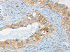 The image on the left is immunohistochemistry of paraffin-embedded Human cervical cancer tissue using CSB-PA231814 (AANAT Antibody) at dilution 1/40, on the right is treated with fusion protein. (Original magnification: ×200)