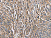 The image on the left is immunohistochemistry of paraffin-embedded Human prostate cancer tissue using CSB-PA223414 (ABI3BP Antibody) at dilution 1/60, on the right is treated with fusion protein. (Original magnification: ×200)