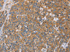 The image on the left is immunohistochemistry of paraffin-embedded Human esophagus cancer tissue using CSB-PA070925 (ACTN4 Antibody) at dilution 1/60, on the right is treated with fusion protein. (Original magnification: ×200)