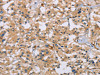 The image on the left is immunohistochemistry of paraffin-embedded Human thyroid cancer tissue using CSB-PA070925 (ACTN4 Antibody) at dilution 1/60, on the right is treated with fusion protein. (Original magnification: ×200)