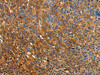 The image on the left is immunohistochemistry of paraffin-embedded Human liver cancer tissue using CSB-PA292969 (ORM2 Antibody) at dilution 1/40, on the right is treated with fusion protein. (Original magnification: ×200)