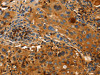 The image on the left is immunohistochemistry of paraffin-embedded Human lung cancer tissue using CSB-PA984269 (ORM2 Antibody) at dilution 1/50, on the right is treated with fusion protein. (Original magnification: ×200)