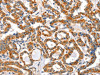 The image on the left is immunohistochemistry of paraffin-embedded Human thyroid cancer tissue using CSB-PA444394 (AIFM3 Antibody) at dilution 1/40, on the right is treated with fusion protein. (Original magnification: ×200)