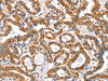 The image on the left is immunohistochemistry of paraffin-embedded Human thyroid cancer tissue using CSB-PA444394 (AIFM3 Antibody) at dilution 1/40, on the right is treated with fusion protein. (Original magnification: ×200)