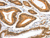 The image on the left is immunohistochemistry of paraffin-embedded Human colon cancer tissue using CSB-PA444394 (AIFM3 Antibody) at dilution 1/40, on the right is treated with fusion protein. (Original magnification: ×200)
