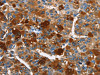 The image on the left is immunohistochemistry of paraffin-embedded Human liver cancer tissue using CSB-PA617569 (ARMCX2 Antibody) at dilution 1/40, on the right is treated with fusion protein. (Original magnification: ×200)