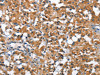 The image on the left is immunohistochemistry of paraffin-embedded Human thyroid cancer tissue using CSB-PA617569 (ARMCX2 Antibody) at dilution 1/40, on the right is treated with fusion protein. (Original magnification: ×200)
