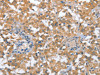 The image on the left is immunohistochemistry of paraffin-embedded Human thyroid cancer tissue using CSB-PA287469 (TP53BP2 Antibody) at dilution 1/35, on the right is treated with fusion protein. (Original magnification: ×200)