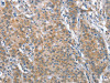 The image on the left is immunohistochemistry of paraffin-embedded Human gastric cancer tissue using CSB-PA287469 (TP53BP2 Antibody) at dilution 1/35, on the right is treated with fusion protein. (Original magnification: ×200)