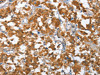 The image on the left is immunohistochemistry of paraffin-embedded Human thyroid cancer tissue using CSB-PA948343 (TP53BP2 Antibody) at dilution 1/35, on the right is treated with fusion protein. (Original magnification: ×200)