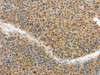 The image on the left is immunohistochemistry of paraffin-embedded Human liver cancer tissue using CSB-PA056430 (ACLY Antibody) at dilution 1/40, on the right is treated with fusion protein. (Original magnification: ×200)