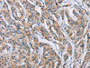 The image on the left is immunohistochemistry of paraffin-embedded Human prostate cancer tissue using CSB-PA983266 (ATP2C1 Antibody) at dilution 1/50, on the right is treated with fusion protein. (Original magnification: ×200)