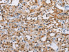 The image on the left is immunohistochemistry of paraffin-embedded Human thyroid cancer tissue using CSB-PA219113 (ATXN1 Antibody) at dilution 1/40, on the right is treated with fusion protein. (Original magnification: ×200)
