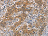 The image is immunohistochemistry of paraffin-embedded Human gastic cancer tissue using CSB-PA577711 (AXIN2 Antibody) at dilution 1/20. (Original magnification: ×200)