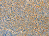 The image on the left is immunohistochemistry of paraffin-embedded Human liver cancer tissue using CSB-PA594088 (VTCN1 Antibody) at dilution 1/30, on the right is treated with fusion protein. (Original magnification: ×200)