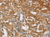 The image on the left is immunohistochemistry of paraffin-embedded Human thyroid cancer tissue using CSB-PA179766 (BCAP31 Antibody) at dilution 1/30, on the right is treated with fusion protein. (Original magnification: ×200)