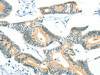 The image on the left is immunohistochemistry of paraffin-embedded Human colon cancer tissue using CSB-PA928784 (BCAT1 Antibody) at dilution 1/50, on the right is treated with fusion protein. (Original magnification: ×200)