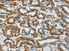 The image on the left is immunohistochemistry of paraffin-embedded Human thyroid cancer tissue using CSB-PA842510 (BCAT2 Antibody) at dilution 1/70, on the right is treated with fusion protein. (Original magnification: ×200)