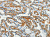 The image on the left is immunohistochemistry of paraffin-embedded Human thyroid cancer tissue using CSB-PA129399 (BCAT2 Antibody) at dilution 1/50, on the right is treated with fusion protein. (Original magnification: ×200)