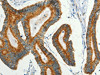 The image on the left is immunohistochemistry of paraffin-embedded Human colon cancer tissue using CSB-PA129399 (BCAT2 Antibody) at dilution 1/50, on the right is treated with fusion protein. (Original magnification: ×200)