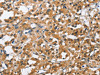The image on the left is immunohistochemistry of paraffin-embedded Human thyroid cancer tissue using CSB-PA057007 (BCL10 Antibody) at dilution 1/40, on the right is treated with fusion protein. (Original magnification: ×200)