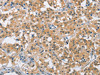 The image on the left is immunohistochemistry of paraffin-embedded Human thyroid cancer tissue using CSB-PA390581 (BCL10 Antibody) at dilution 1/40, on the right is treated with fusion protein. (Original magnification: ×200)