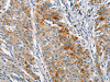 The image on the left is immunohistochemistry of paraffin-embedded Human gastric cancer tissue using CSB-PA390581 (BCL10 Antibody) at dilution 1/40, on the right is treated with fusion protein. (Original magnification: ×200)