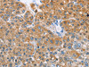 The image on the left is immunohistochemistry of paraffin-embedded Human liver cancer tissue using CSB-PA796730 (BDH1 Antibody) at dilution 1/60, on the right is treated with fusion protein. (Original magnification: ×200)