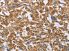The image on the left is immunohistochemistry of paraffin-embedded Human thyroid cancer tissue using CSB-PA114413 (COPB1 Antibody) at dilution 1/50, on the right is treated with fusion protein. (Original magnification: ×200) The image on the left is immunohistochemistry of paraffin-embedded Human thyroid cancer tissue using CSB-PA114413 (COPB1 Antibody) at dilution 1/50, on the right is treated with fusion protein. (Original magnification: ×200)