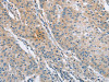 The image on the left is immunohistochemistry of paraffin-embedded Human gastic cancer tissue using CSB-PA037961 (SH3GLB1 Antibody) at dilution 1/30, on the right is treated with fusion protein. (Original magnification: ×200)