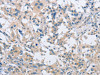 The image on the left is immunohistochemistry of paraffin-embedded Human thyroid cancer tissue using CSB-PA037961 (SH3GLB1 Antibody) at dilution 1/30, on the right is treated with fusion protein. (Original magnification: ×200)
