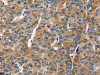 The image on the left is immunohistochemistry of paraffin-embedded Human liver cancer tissue using CSB-PA157570 (BGN Antibody) at dilution 1/50, on the right is treated with fusion protein. (Original magnification: ×200)