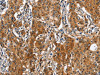The image on the left is immunohistochemistry of paraffin-embedded Human gastic cancer tissue using CSB-PA203218 (BGN Antibody) at dilution 1/50, on the right is treated with fusion protein. (Original magnification: ×200)