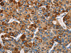 The image on the left is immunohistochemistry of paraffin-embedded Human liver cancer tissue using CSB-PA171015 (SLAMF8 Antibody) at dilution 1/40, on the right is treated with fusion protein. (Original magnification: ×200)
