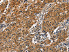 The image on the left is immunohistochemistry of paraffin-embedded Human gastric cancer tissue using CSB-PA921557 (SLAMF8 Antibody) at dilution 1/50, on the right is treated with fusion protein. (Original magnification: ×200)