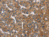 The image on the left is immunohistochemistry of paraffin-embedded Human liver cancer tissue using CSB-PA926374 (BLK Antibody) at dilution 1/20, on the right is treated with fusion protein. (Original magnification: ×200)