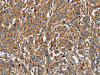 The image on the left is immunohistochemistry of paraffin-embedded Human gastric cancer tissue using CSB-PA237032 (BLK Antibody) at dilution 1/20, on the right is treated with fusion protein. (Original magnification: ×200)
