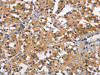 The image on the left is immunohistochemistry of paraffin-embedded Human thyroid cancer tissue using CSB-PA047722 (BRE Antibody) at dilution 1/40, on the right is treated with fusion protein. (Original magnification: ×200)